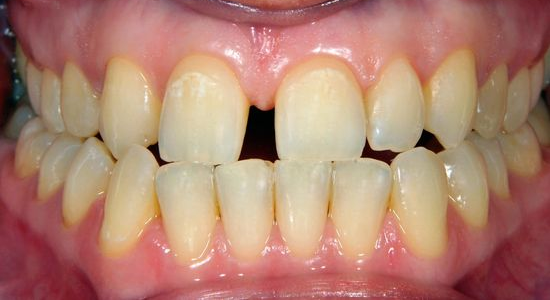 Close-up of human teeth, showing a gap between the two front teeth, with slight discoloration.