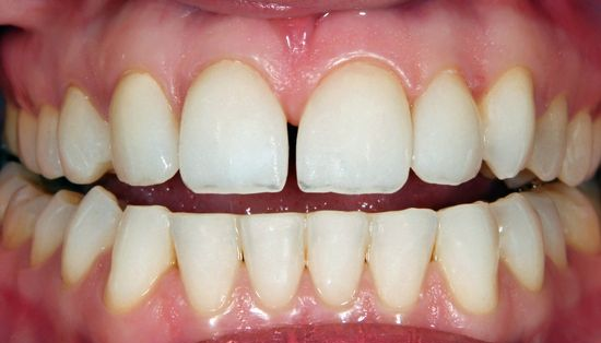 Close-up of human teeth, showing a gap between the two front teeth. The teeth are white.