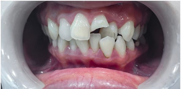 Close-up of a person's teeth showing crooked, chipped, and misaligned teeth in a mouth.