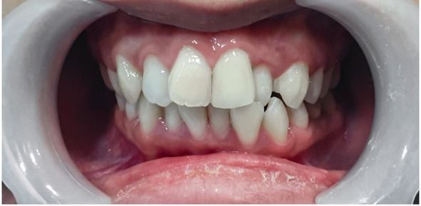 Teeth with a dental retractor. Upper front teeth are white, some are crooked. Gum tissue is visible.