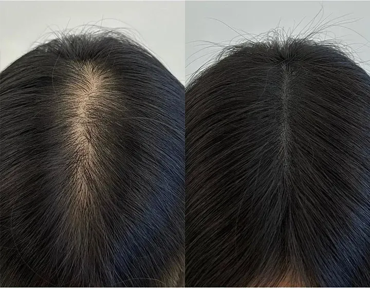 Scalp Restoration, SMP