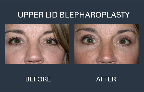 Before and after photos showing an upper eyelid blepharoplasty, reducing eyelid droopiness.