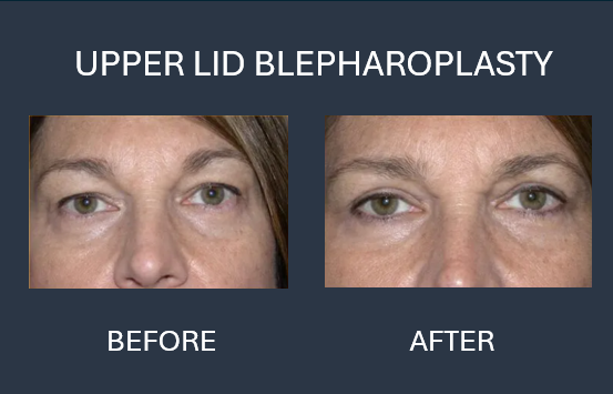 Side-by-side comparison of woman's eyes, before and after upper lid blepharoplasty surgery. The after eye has less eyelid skin.