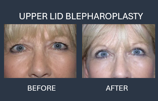 Before/after comparison of eyes after upper eyelid blepharoplasty and facial injections.