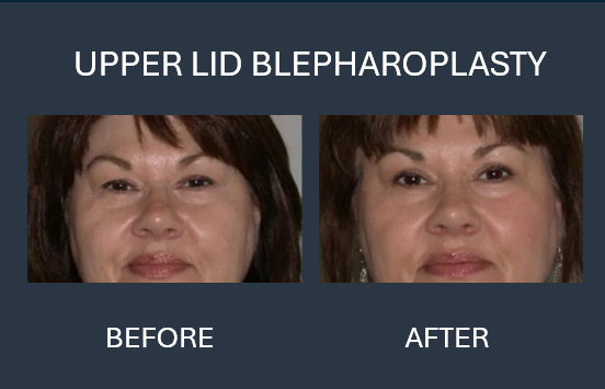 Before-and-after of a person's eyes after upper and lower eyelid blepharoplasty, showing reduced puffiness and wrinkles.