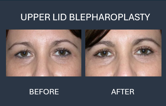 Before and after photos showing reduced eyelid puffiness after blepharoplasty surgery.