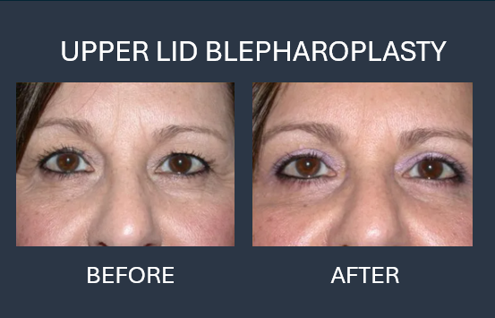 Before and after photos showing eyelid blepharoplasty results: eyes with excess skin and then with a refreshed appearance.