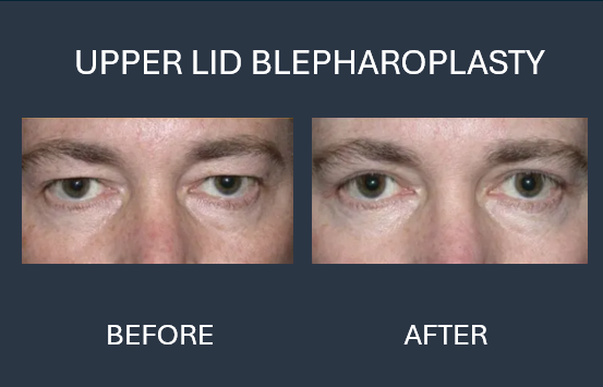 Before-and-after of a person's eyes after upper eyelid blepharoplasty. Sagging skin lifted, eyes appear more open.