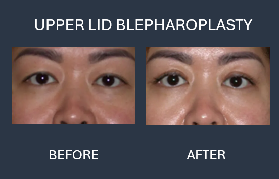 Before and after photo of a woman's eyes. Before shows dark circles, after shows improved appearance after eyelid surgery and injections.