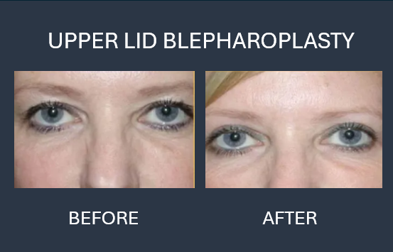 Before and after comparison of upper eyelid blepharoplasty surgery. The after image shows reduced eyelid drooping.