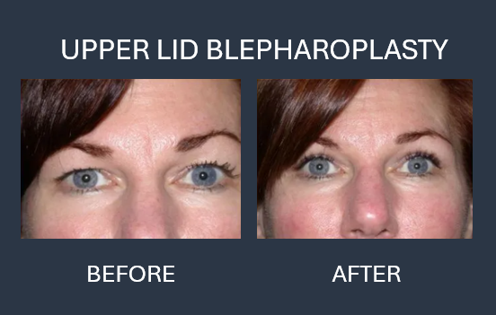 Before and after photos showing results of upper and lower eyelid blepharoplasty; reduced puffiness and wrinkles.