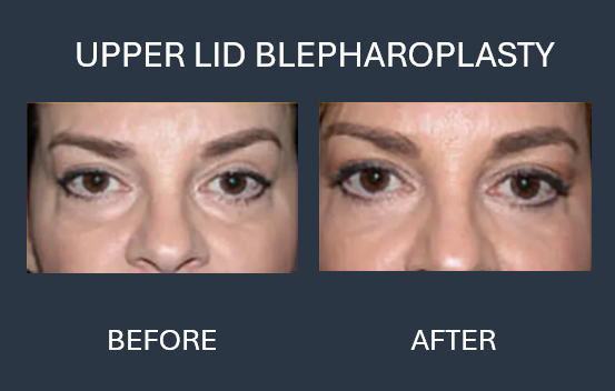 Before/after comparison of a woman's eyes after an endoscopic brow lift and upper lid blepharoplasty.