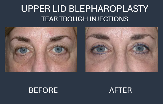Before and after photos of eyes after upper lid blepharoplasty surgery. The upper eyelids appear less droopy after the procedure.