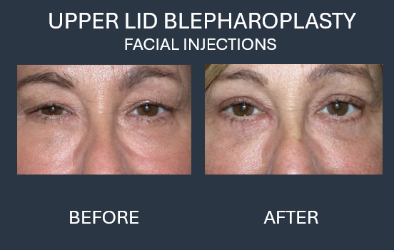 Before and after photos showing reduced eyelid puffiness following blepharoplasty.