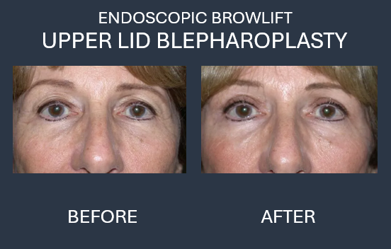 Comparison of woman's eyes before and after upper eyelid blepharoplasty; eyelid skin removed, eyes look more open.