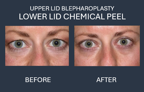 Before and after view of eyes, showing upper and lower lid blepharoplasty.