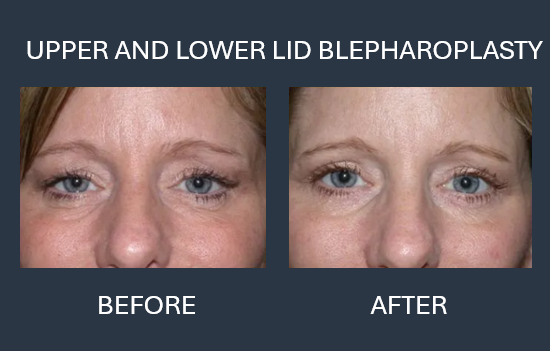 Before and after photos of a person's eyes, showing results of upper eyelid blepharoplasty.
