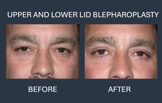 Before and after photos of a person's eyes after an upper lid blepharoplasty. The 