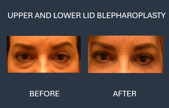 Before and after photos of a woman's eyes following an upper lid blepharoplasty surgery. The after photo shows less drooping.