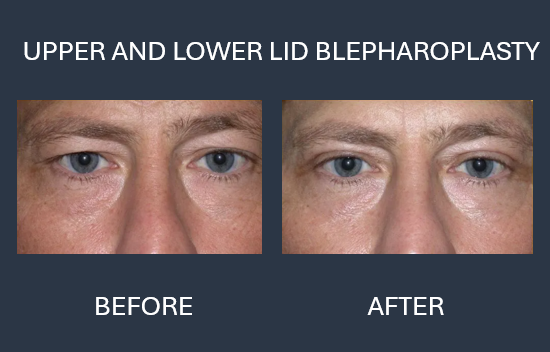 Before and after comparison of upper eyelid blepharoplasty; eyes looking up, less eyelid droop after surgery.