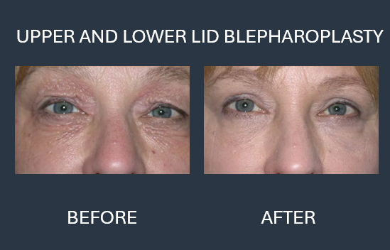 Before and after comparison of upper eyelid blepharoplasty surgery. The after image shows reduced eyelid drooping.