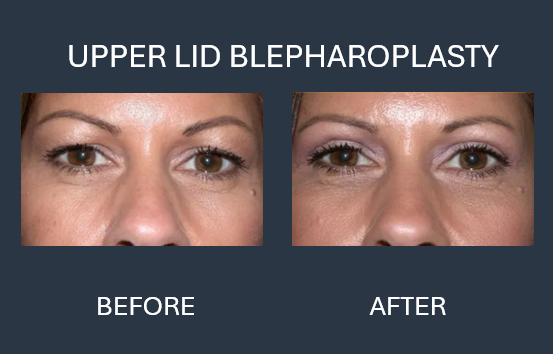 Before and after photos showing eyes after upper eyelid blepharoplasty and lower lid chemical peel; eyelid changes are visible.
