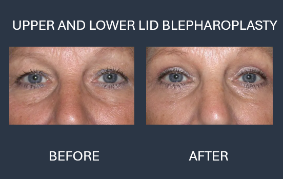 Before and after of upper and lower lid blepharoplasty, showing improved eye appearance.
