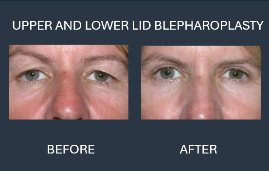 Upper and lower lid blepharoplasty results: before and after photos of a person's eyes, showing reduced eyelid puffiness.
