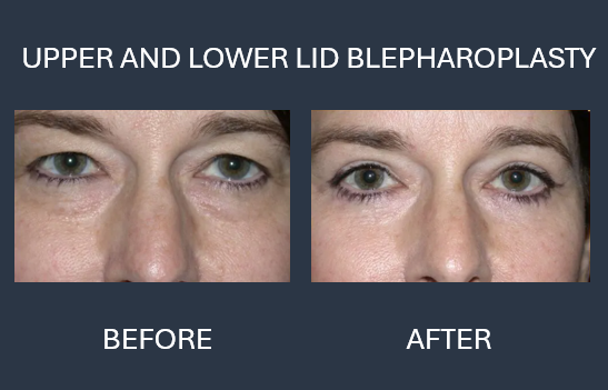 Before and after photos of a woman's eyes following an upper lid blepharoplasty; eyes appear more open in the 