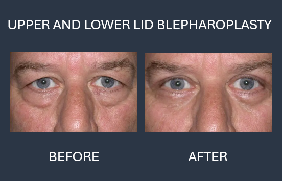 Comparison of a person's eyes before and after upper eyelid blepharoplasty.