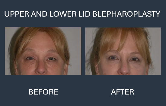 Before-and-after photos of a woman's face, demonstrating upper eyelid blepharoplasty. The 
