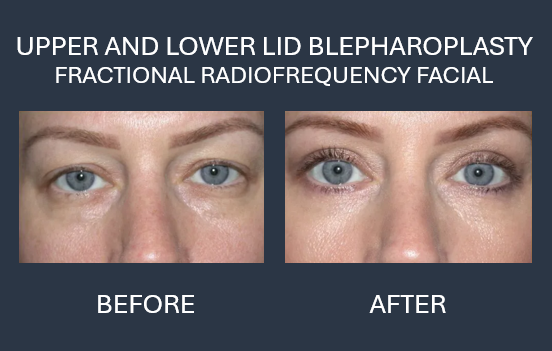 Upper and lower lid blepharoplasty results: before and after photos of a person's eyes, showing reduced eyelid puffiness.