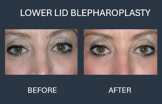 Comparison of eyes before and after upper eyelid blepharoplasty; eyelid lift.