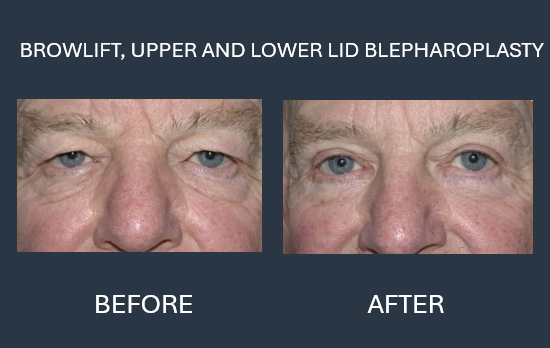 Before and after view of a person’s eyes after upper eyelid blepharoplasty, showing reduced lid sagging.