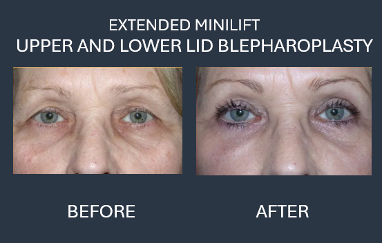 Before-and-after photos of a woman's eyes, showing results of upper and lower eyelid surgery.