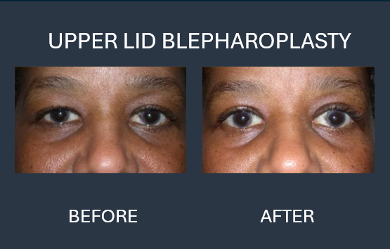 Before-and-after of eyes: Upper lids lifted, bags under eyes removed, resulting in a more open and youthful appearance.