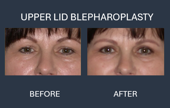 Before and after close-up of eyes. Before shows drooping eyelids and under-eye bags, after shows lifted eyelids and smoother skin.