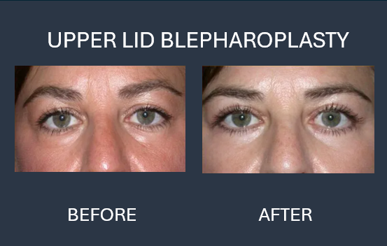 Before and after photos showing blepharoplasty results; reduced upper and lower eyelid puffiness.