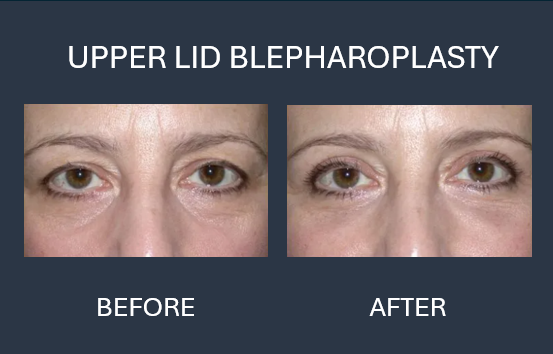 Comparison: Before and after photos of lower eyelid blepharoplasty, showing reduced puffiness.
