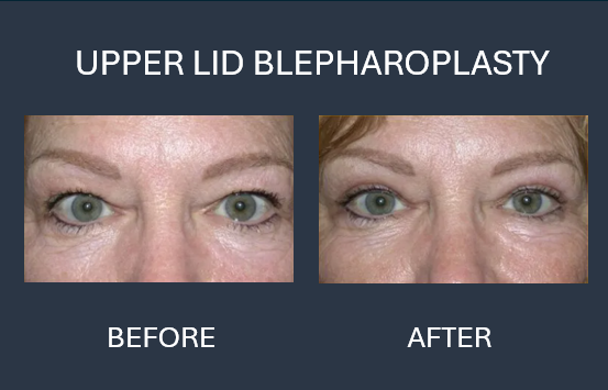 Before and after comparison: blepharoplasty and browlift on an older individual.