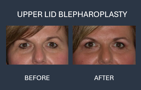 Comparison of eyes before and after extended minilift and blepharoplasty. Left: before, right: after.