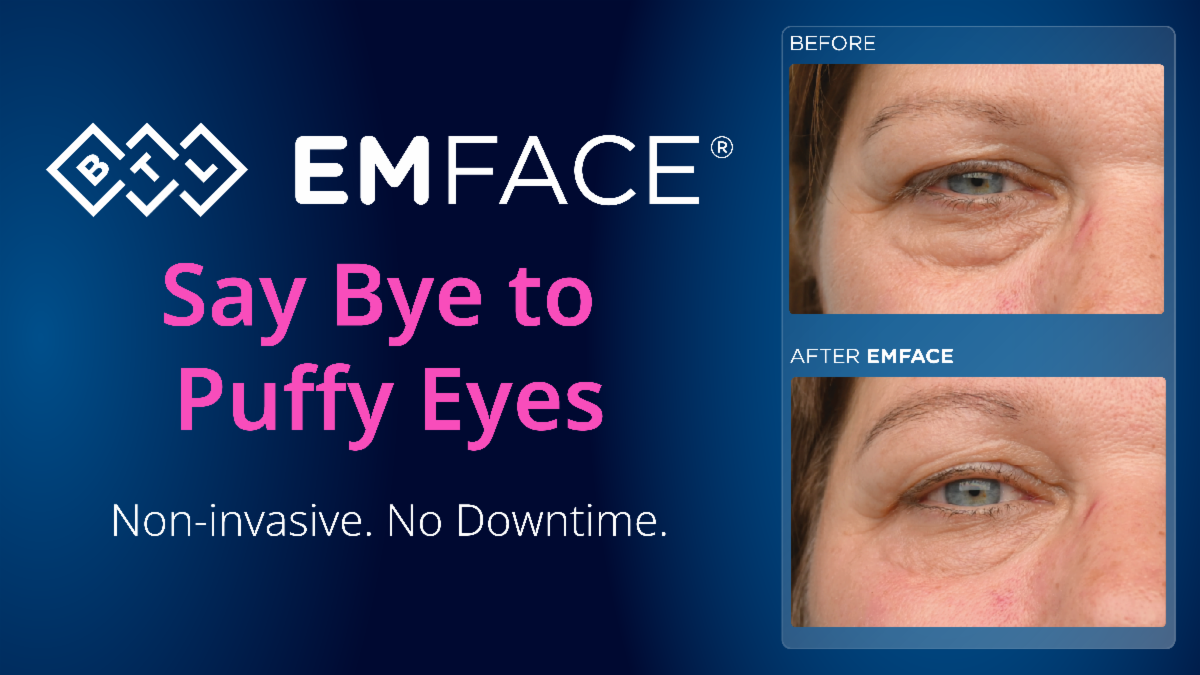 BTL EMFACE ad showing before and after photos of a person's eye area to demonstrate the reduction of puffiness.