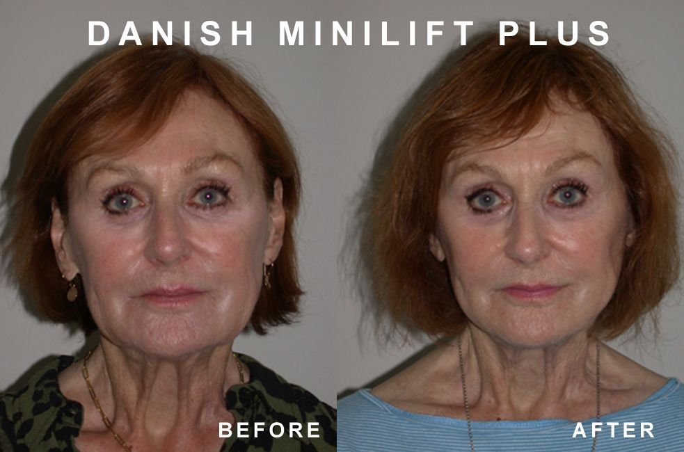 Before and after photos showing a woman's face. Left side: 