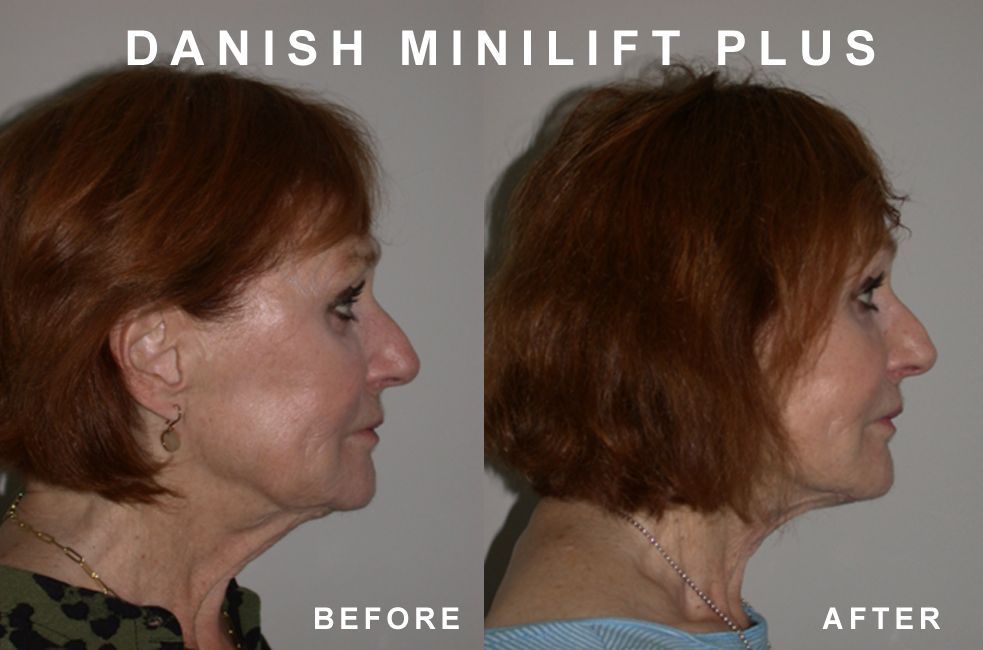 Before-and-after of a neck and face lift. Woman’s neck and jawline appear smoother after the procedure.
