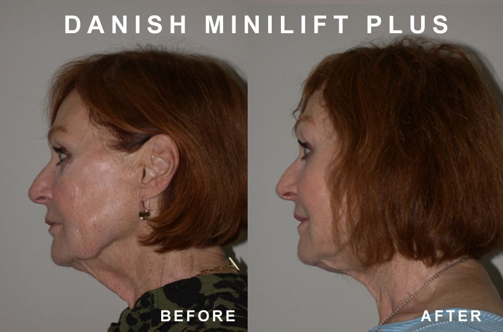 Side-by-side view, showing a woman’s face before and after the Danish MiniLift Plus. The after image shows less sagging.