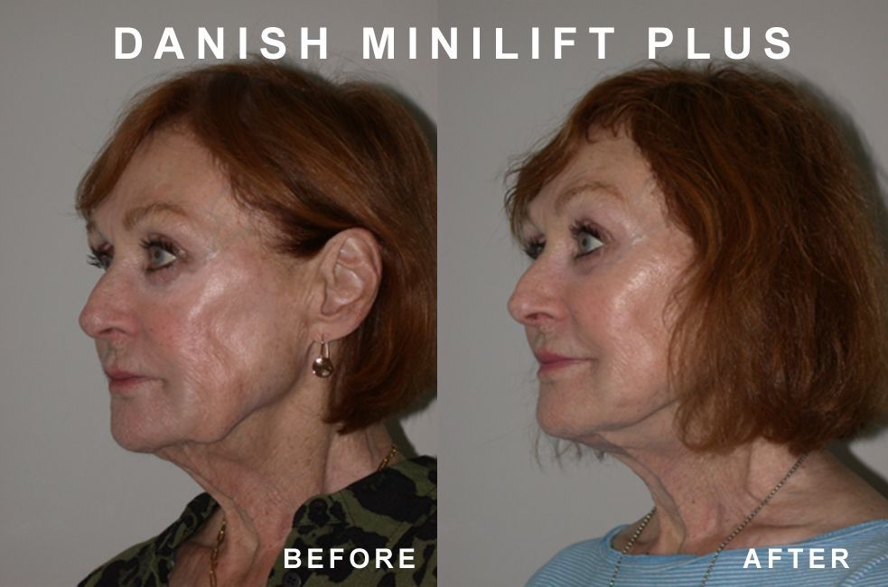 Before and after photos of a woman's face, showing a skin tightening effect from a 