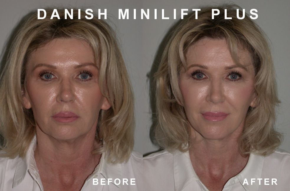 Before and after photos of a woman's face, showing the effects of a Danish MiniLift Plus procedure.