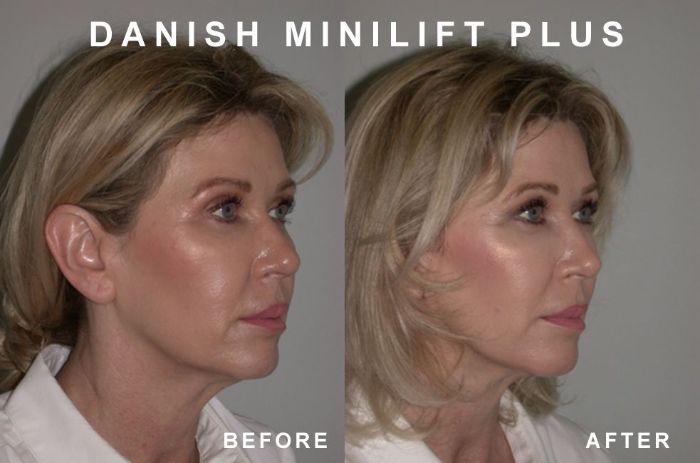 Side-by-side photos: woman's face before and after a Danish MiniLift Plus procedure. The 