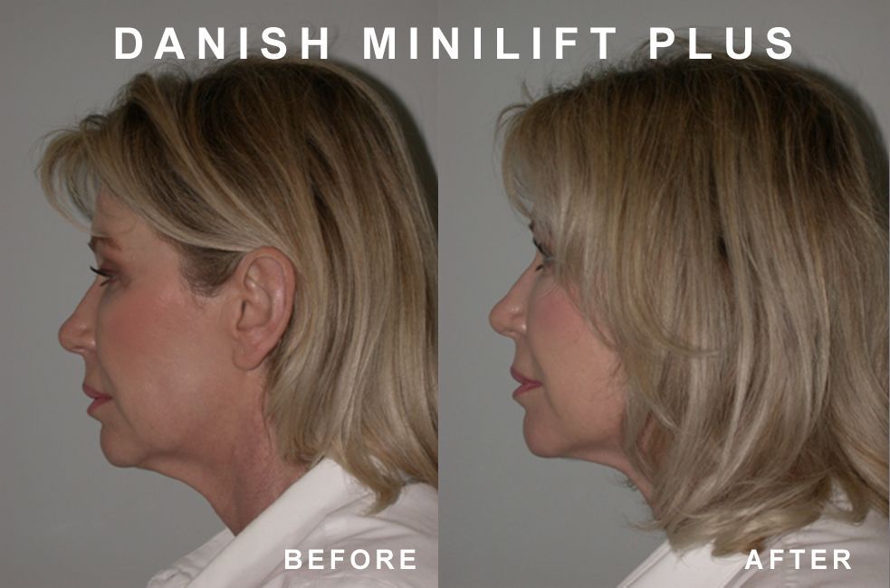 Before and after photos showing a woman's face and neck; the 