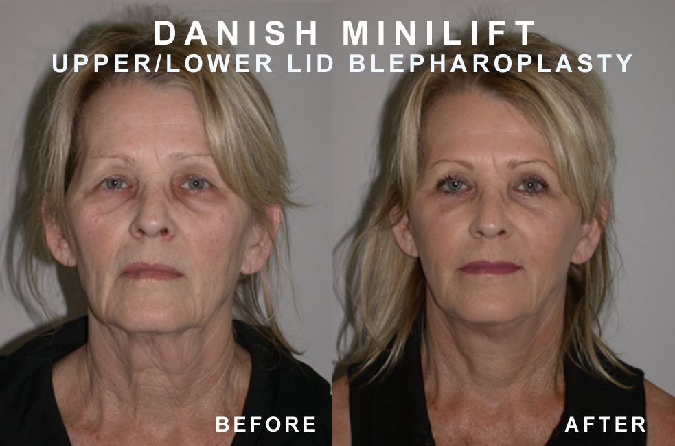Before and after comparison of woman's face after Danish MiniLift and upper/lower eyelid surgery. Skin appears tighter, refreshed.